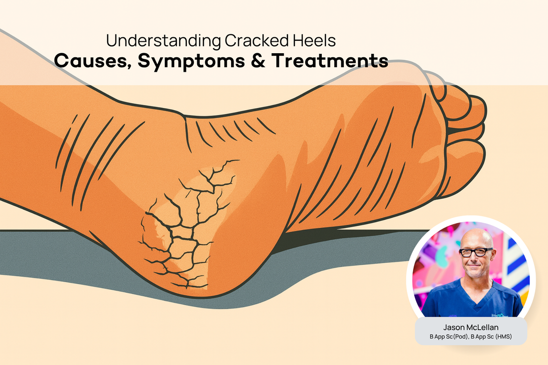 What are Cracked Heels? A Podiatrist Explains the Causes and Treatment